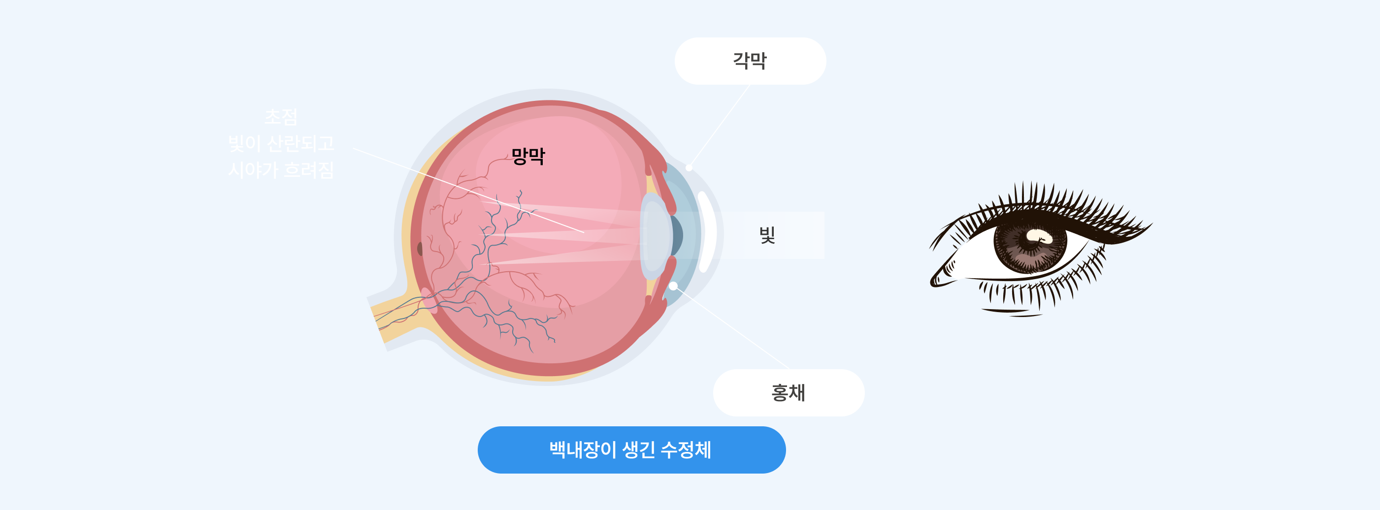 백내장이 생긴 수정체