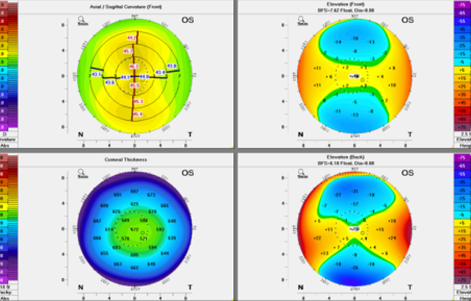 Cornea shape basic analysis