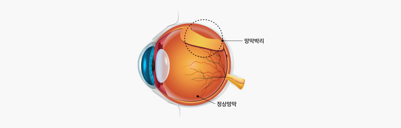 망막박리