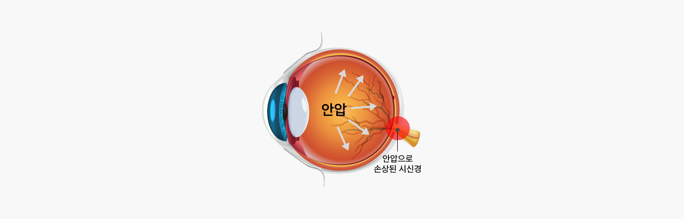 망막박리