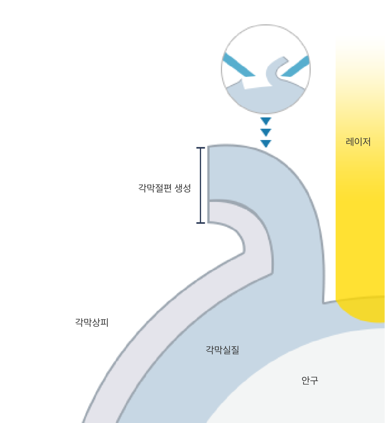 라식수술