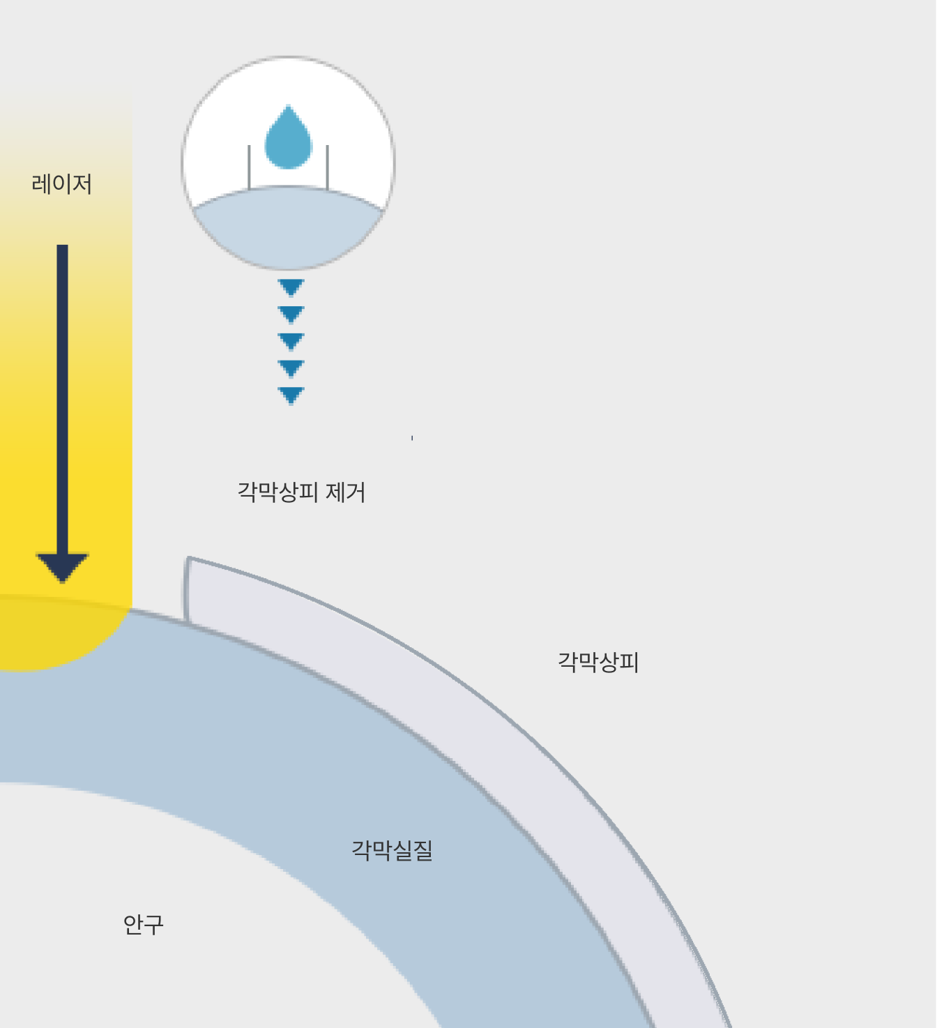 라섹수술