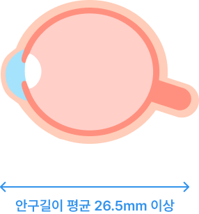 고도근시안