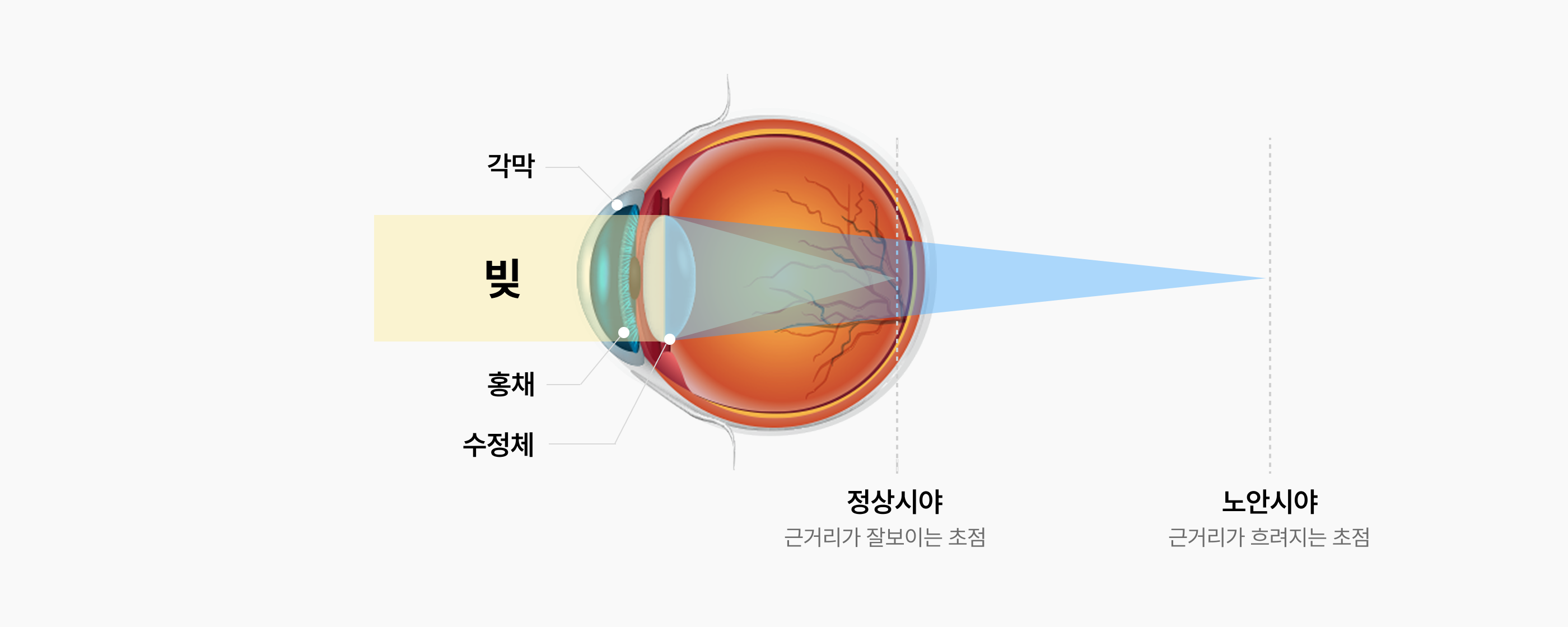 노안