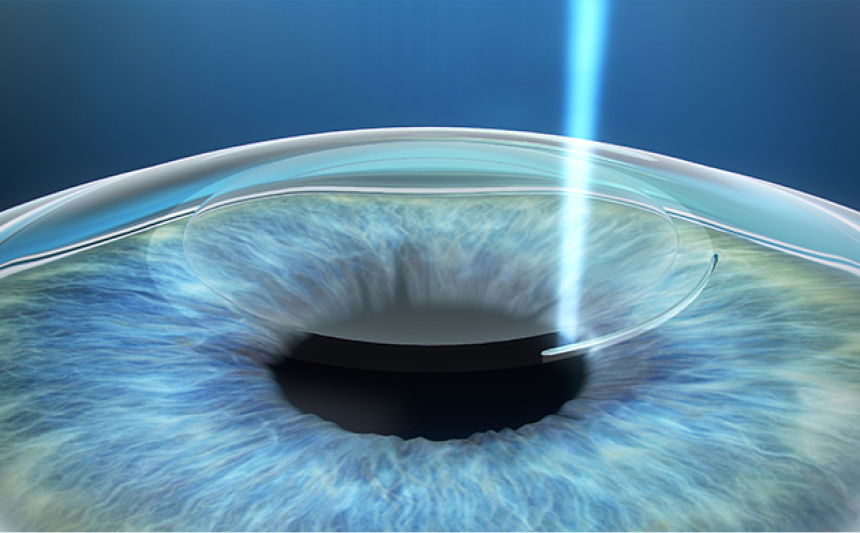Lenticule 생성